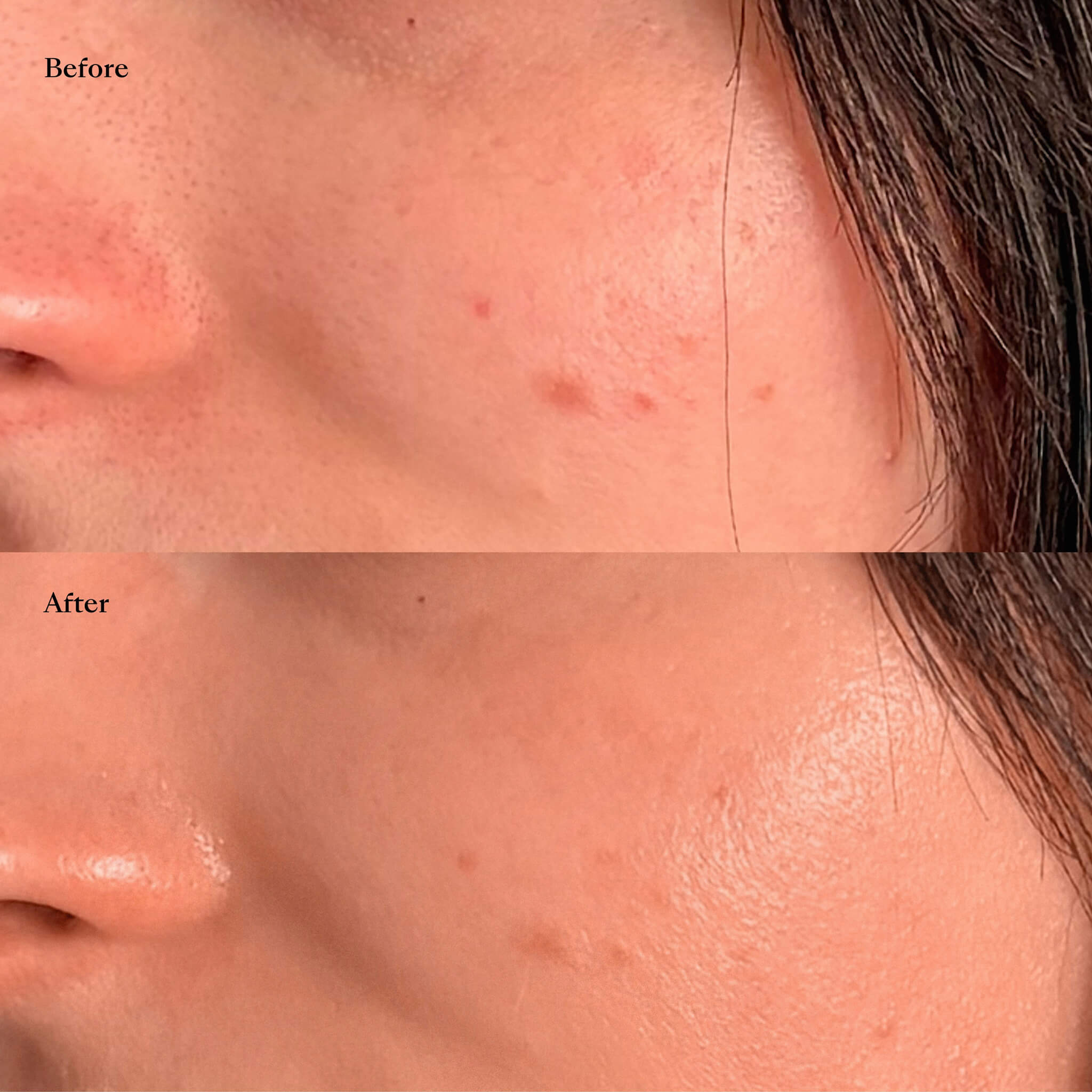 Before and after comparison of skin with acne treatment showing clearer skin texture after laser genesis and the red carpet facial.